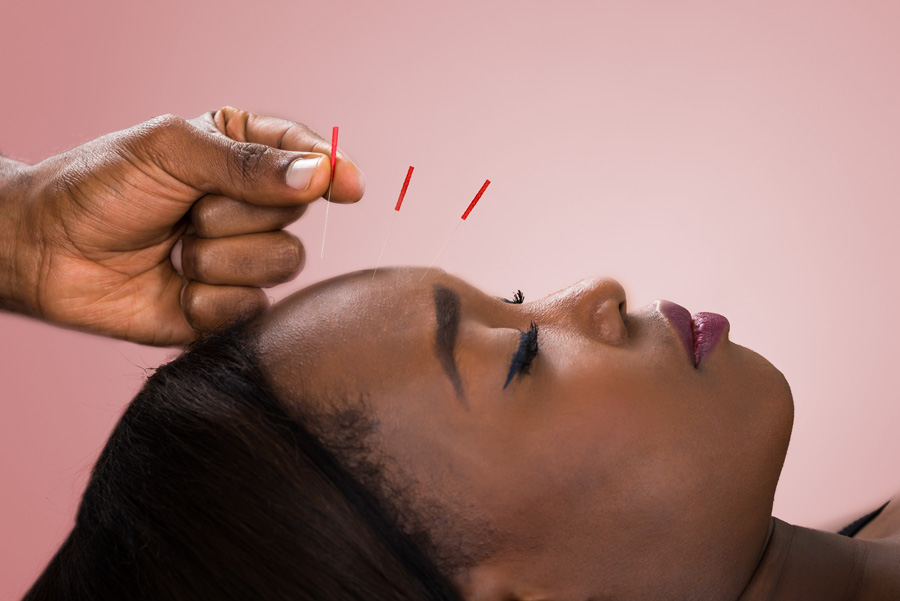 Acupuncture: An Eastern Tool for Treating Acne